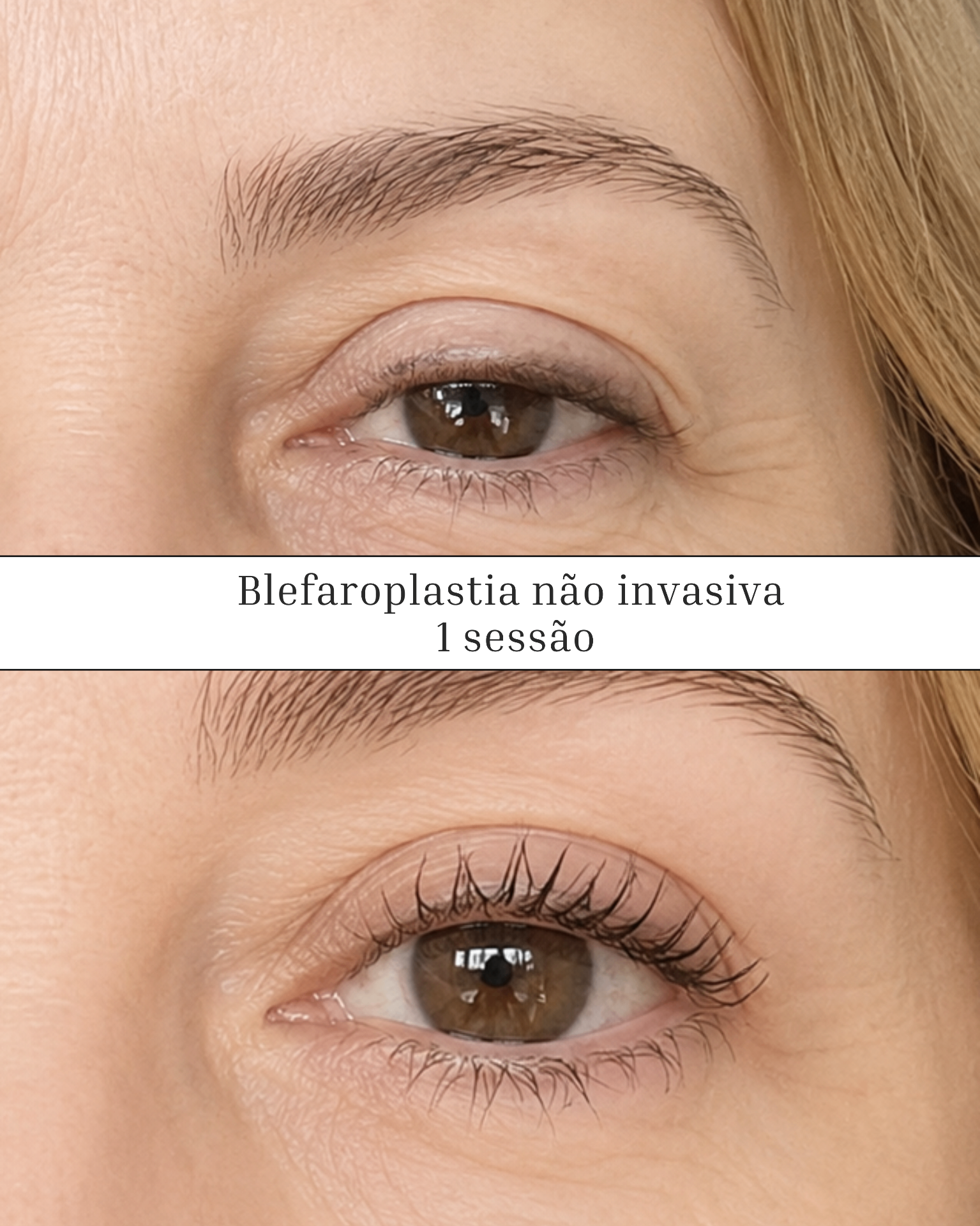 Blefaroplastia