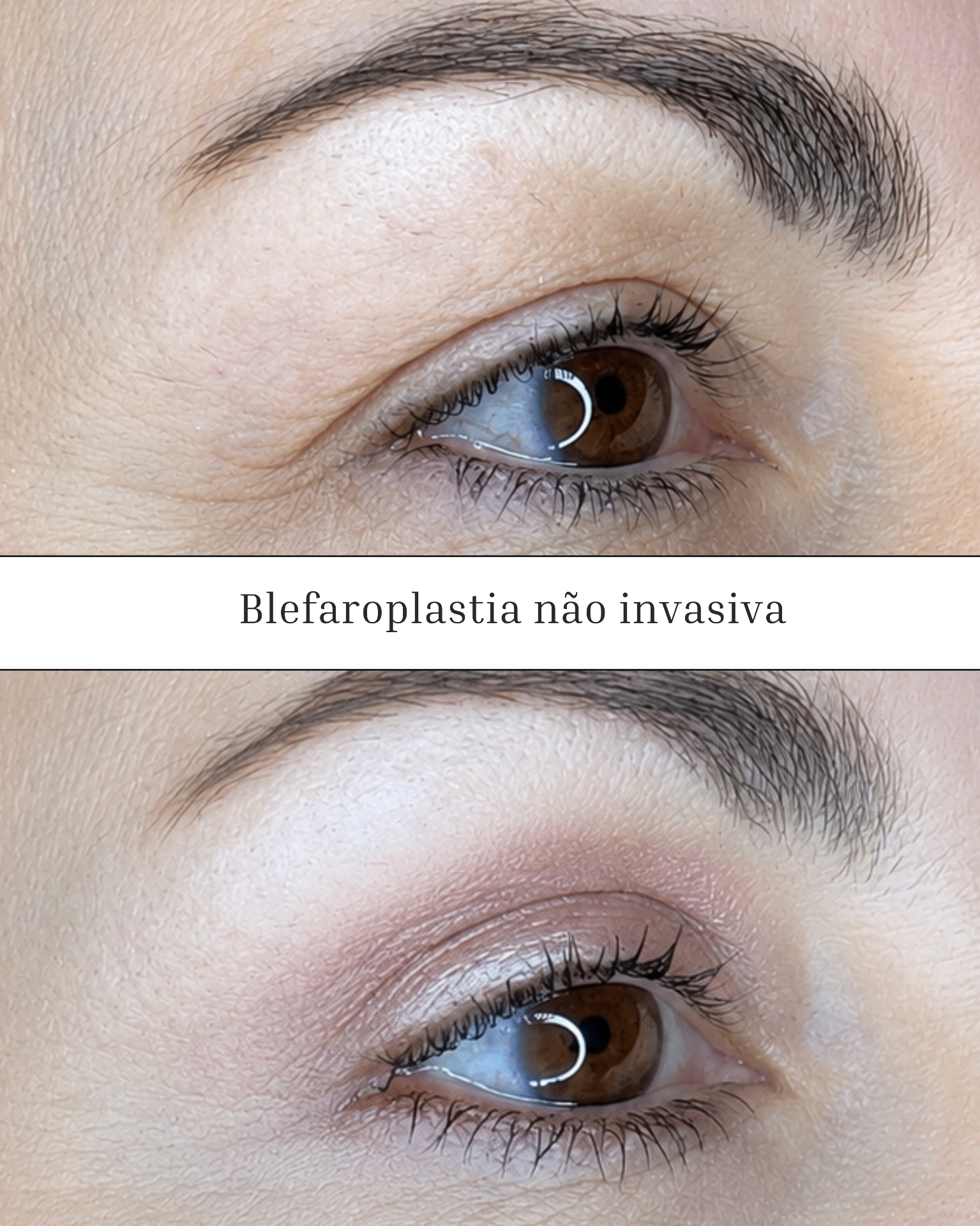 Blefaroplastia