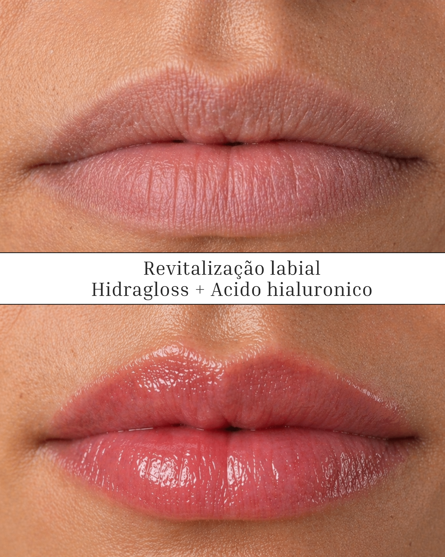 Revitalização Labial